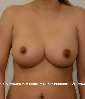 Breast Augmentation Before & After Image