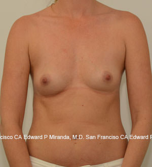 Breast Augmentation Before & After Image