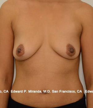 Breast Augmentation Before & After Image