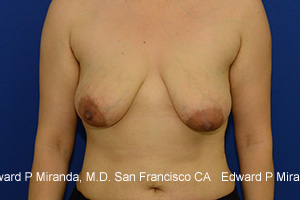 Breast Lift Before & After Image