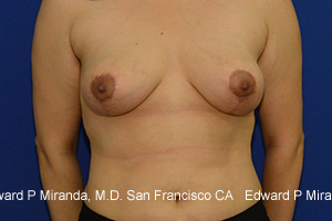 Breast Lift Before & After Image