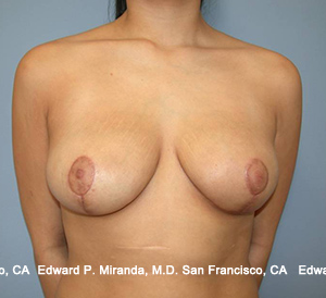 Breast Lift Before & After Image