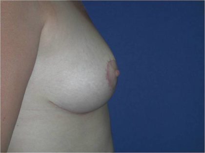 Breast Reduction Before & After Image