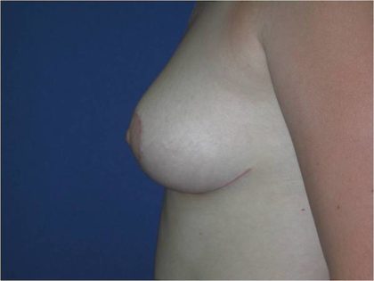 Breast Reduction Before & After Image