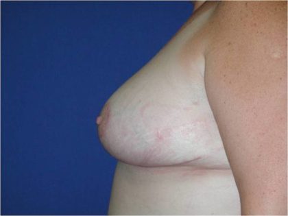 Breast Reduction Before & After Image