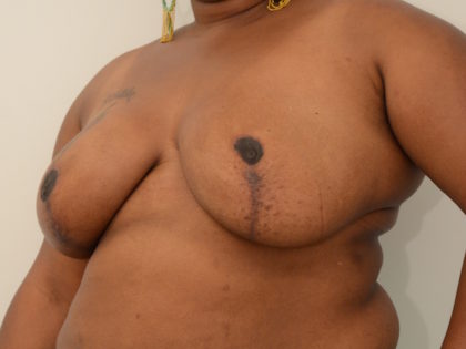 Breast Reduction Before & After Image