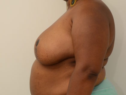 Breast Reduction Before & After Image