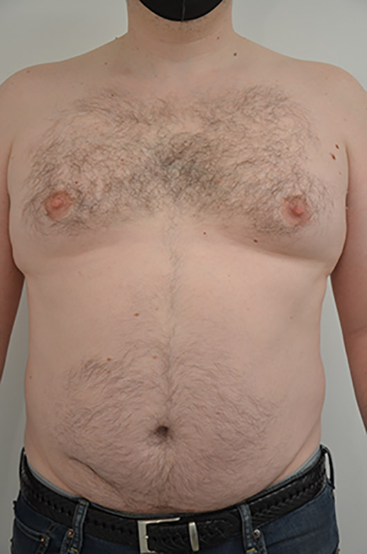 Gynecomastia Before & After Image