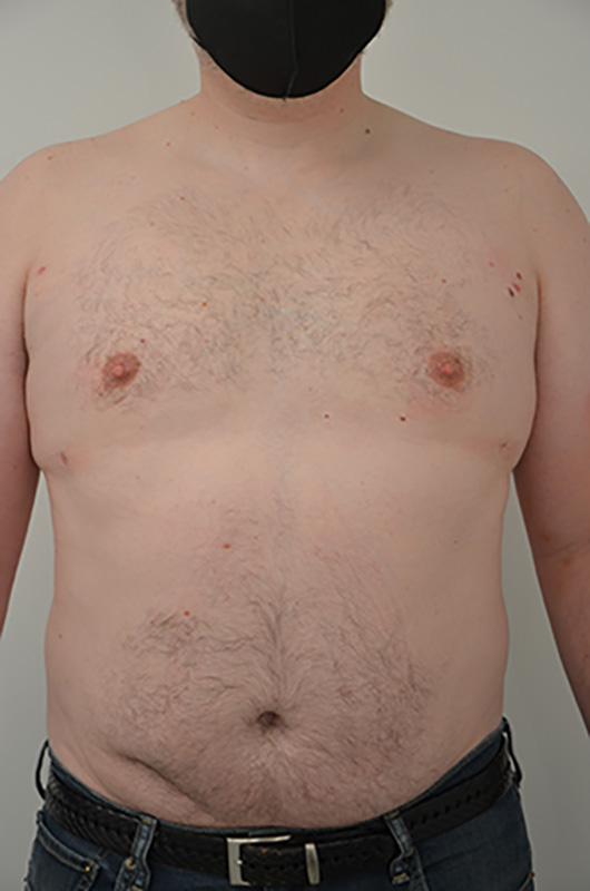 Gynecomastia Before & After Image