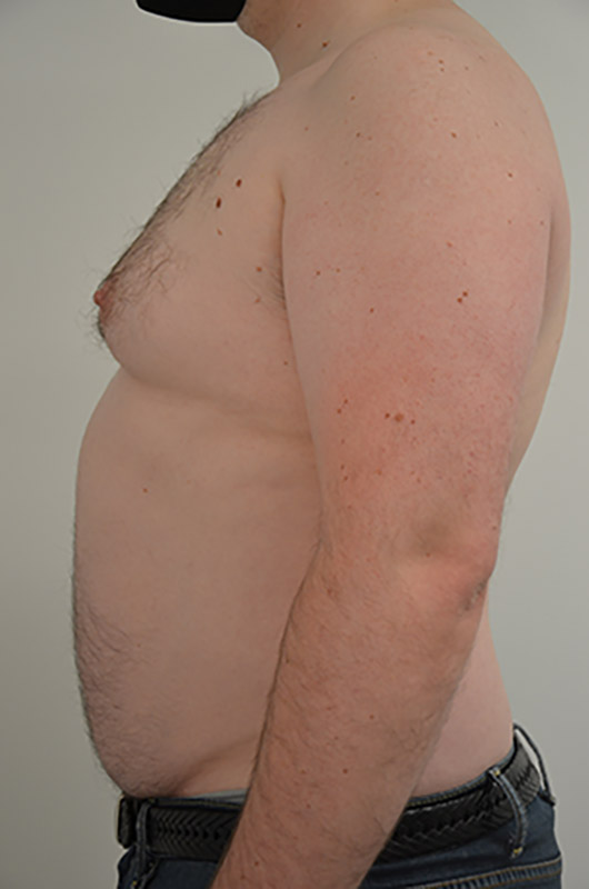 Gynecomastia Before & After Image