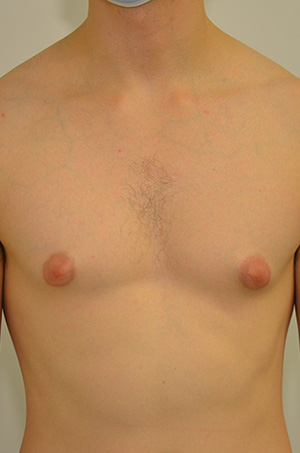 Gynecomastia Before & After Image