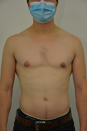 Gynecomastia Before & After Image