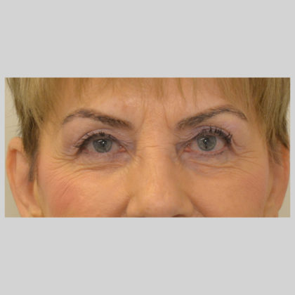 Blepharoplasty Before & After Image