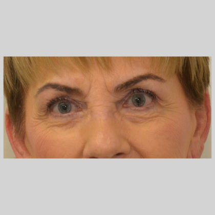 Blepharoplasty Before & After Image