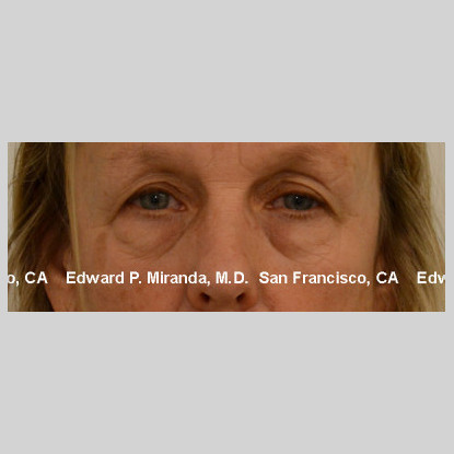 Blepharoplasty Before & After Image