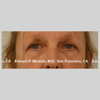 Blepharoplasty Before & After Image