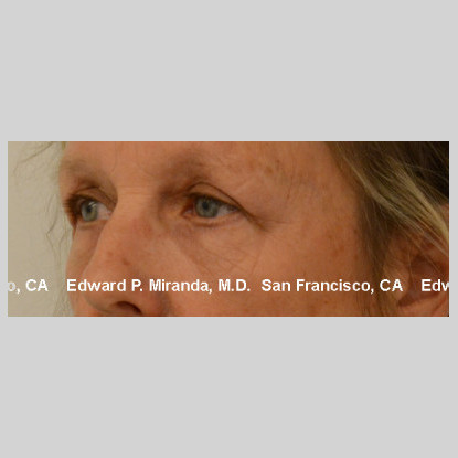 Blepharoplasty Before & After Image