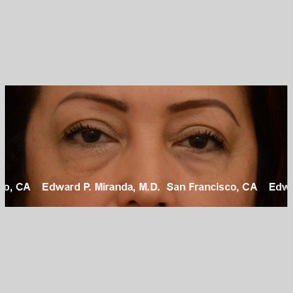 Blepharoplasty Before & After Image