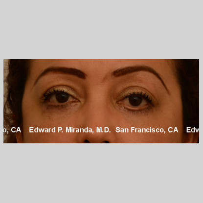 Blepharoplasty Before & After Image