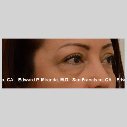 Blepharoplasty Before & After Image