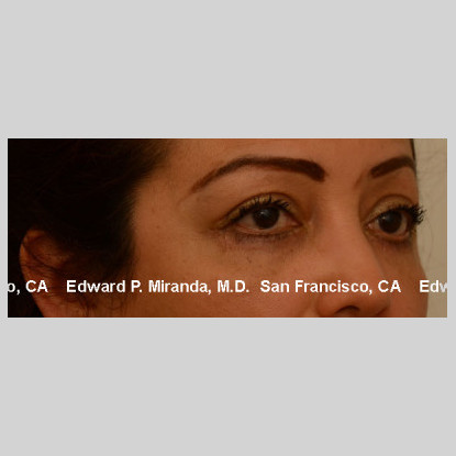 Blepharoplasty Before & After Image