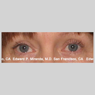 Blepharoplasty Before & After Image