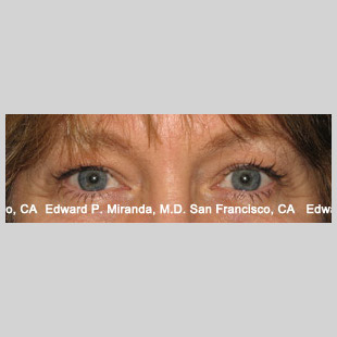 Blepharoplasty Before & After Image