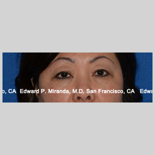 Blepharoplasty Before & After Image