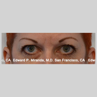 Blepharoplasty Before & After Image