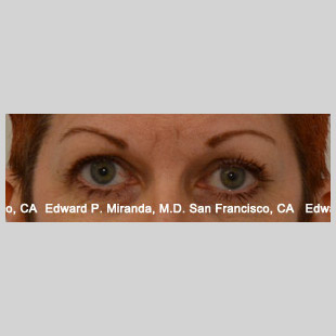 Blepharoplasty Before & After Image