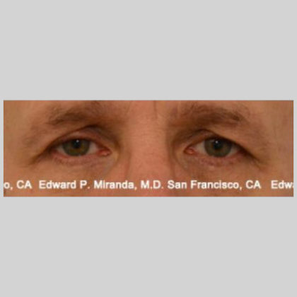 Blepharoplasty Before & After Image