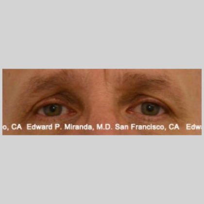 Blepharoplasty Before & After Image