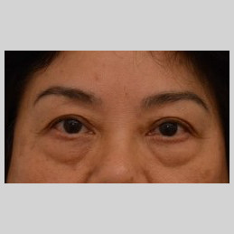 Blepharoplasty Before & After Image