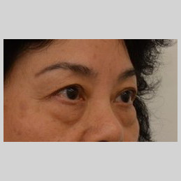 Blepharoplasty Before & After Image