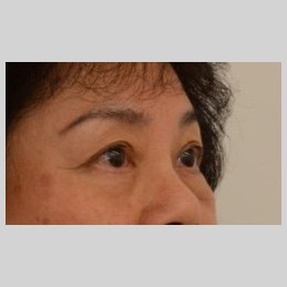 Blepharoplasty Before & After Image