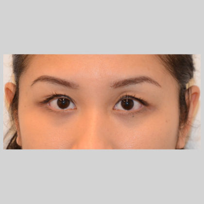 Blepharoplasty Before & After Image