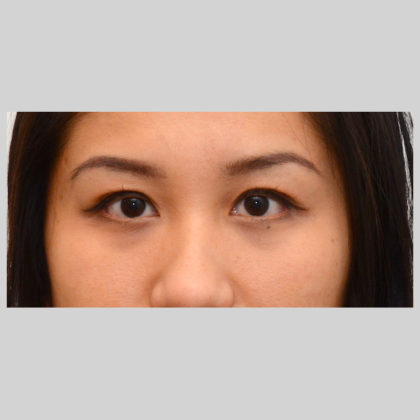 Blepharoplasty Before & After Image