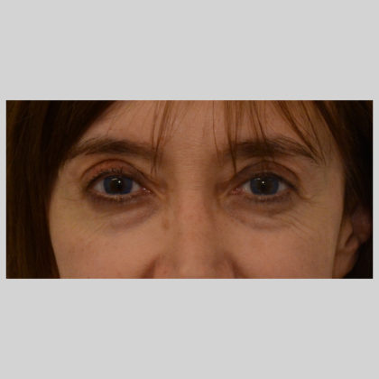 Blepharoplasty Before & After Image