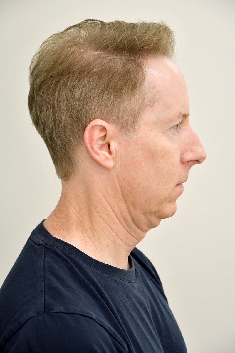 Chin Augmentation Before & After Image