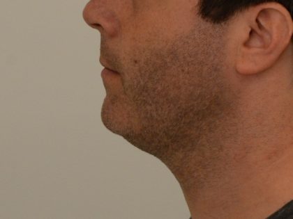 Chin Augmentation Before & After Image