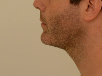 Chin Augmentation Before & After Image