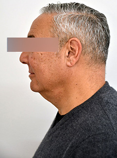 Facelift Before & After Image