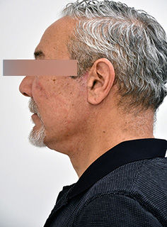 Facelift Before & After Image