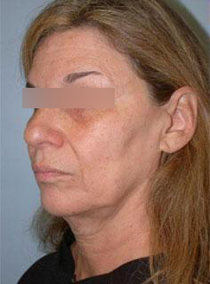 Facelift Before & After Image