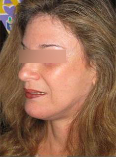 Facelift Before & After Image