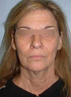 Facelift Before & After Image