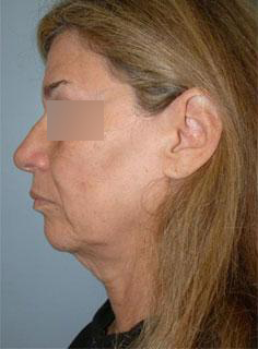 Facelift Before & After Image