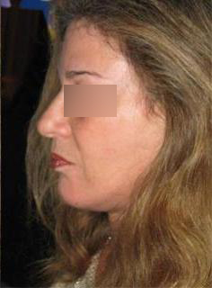 Facelift Before & After Image