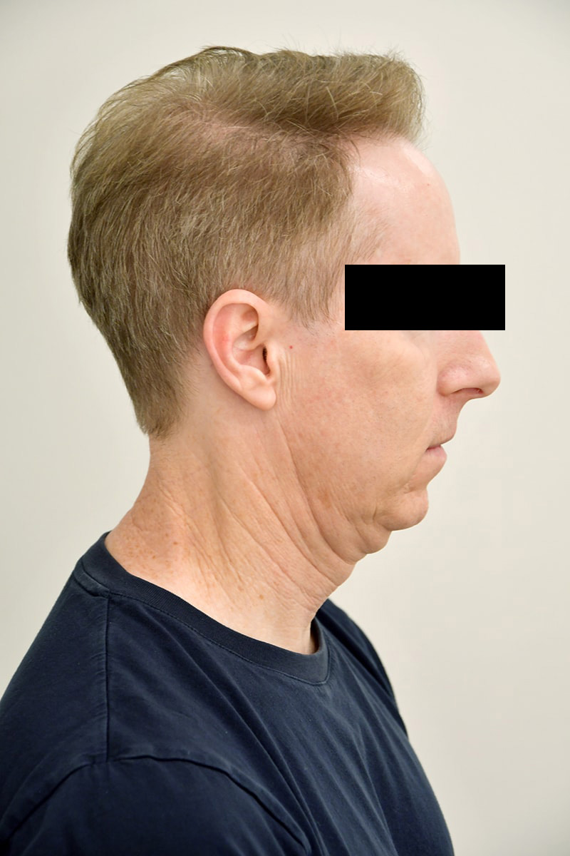 Facelift Before & After Image