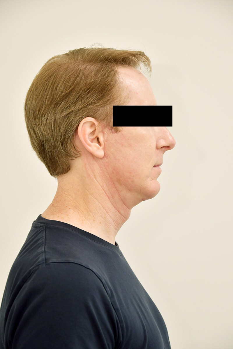 Facelift Before & After Image